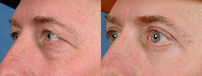 Eyelid Surgery Case 89 Before & After View #2 | Louisville, KY | CaloSpa® Rejuvenation Center