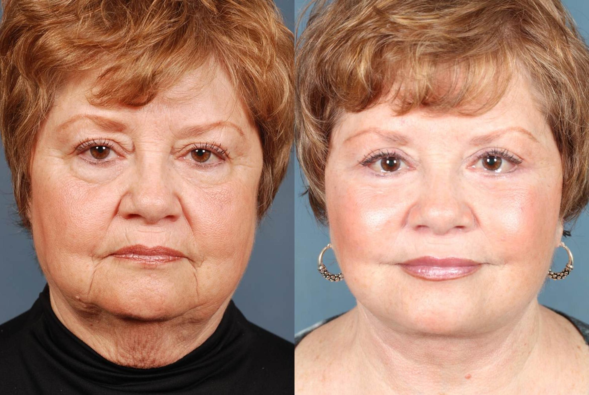 Before & After Facelift Case 242 View #1 View in Louisville, KY
