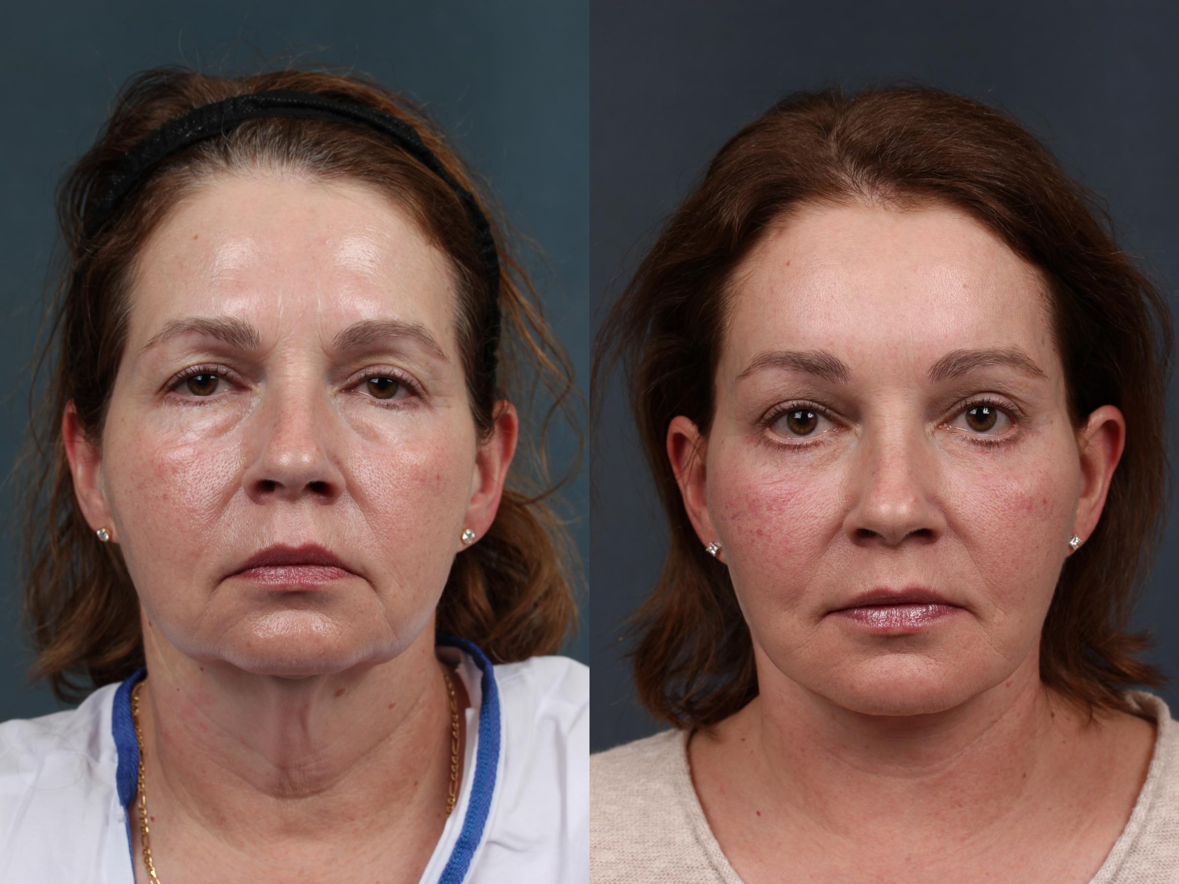 Before & After Facelift Case 281 View #1 View in Louisville & Lexington, KY