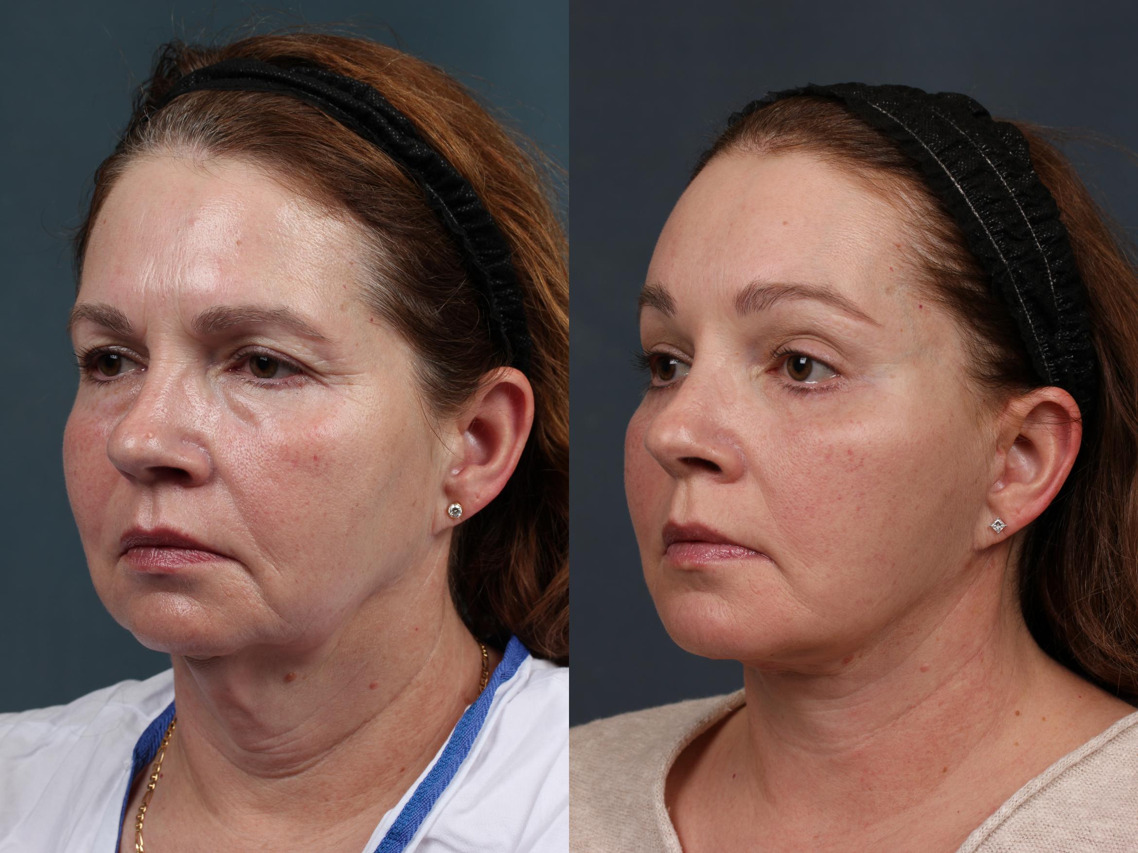 Before & After Facelift Case 281 View #2 View in Louisville & Lexington, KY