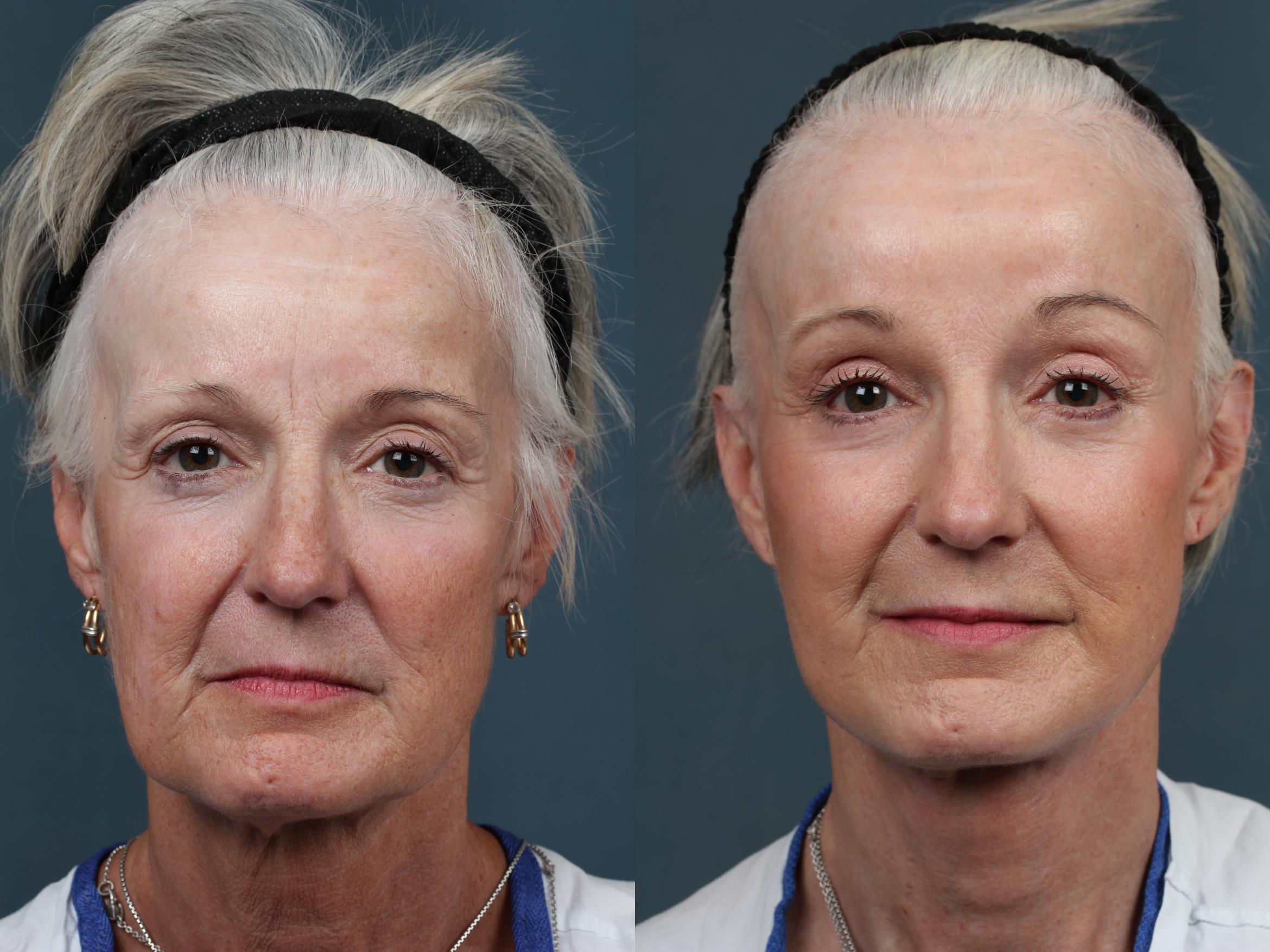 Lower Blepharoplasty and Browlift