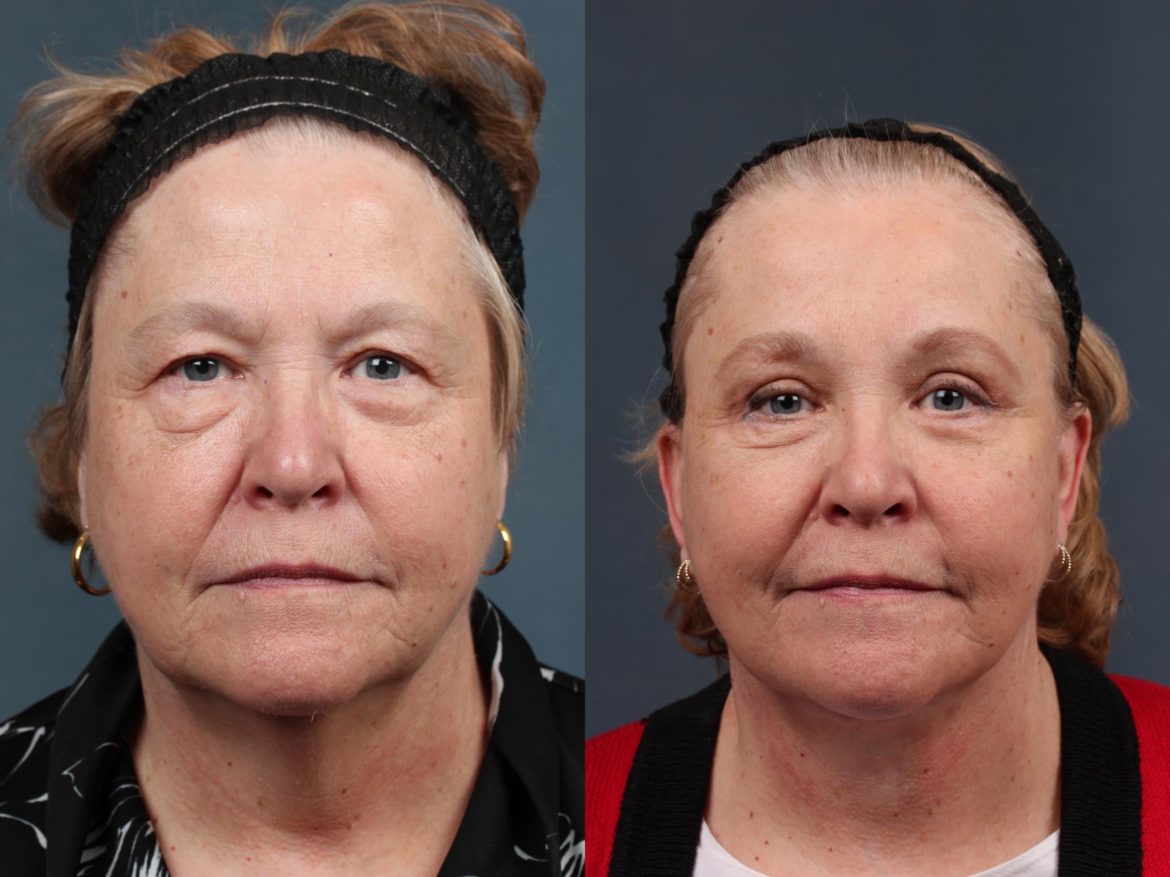 Before & After Facelift Case 492 View #1 View in Louisville, KY