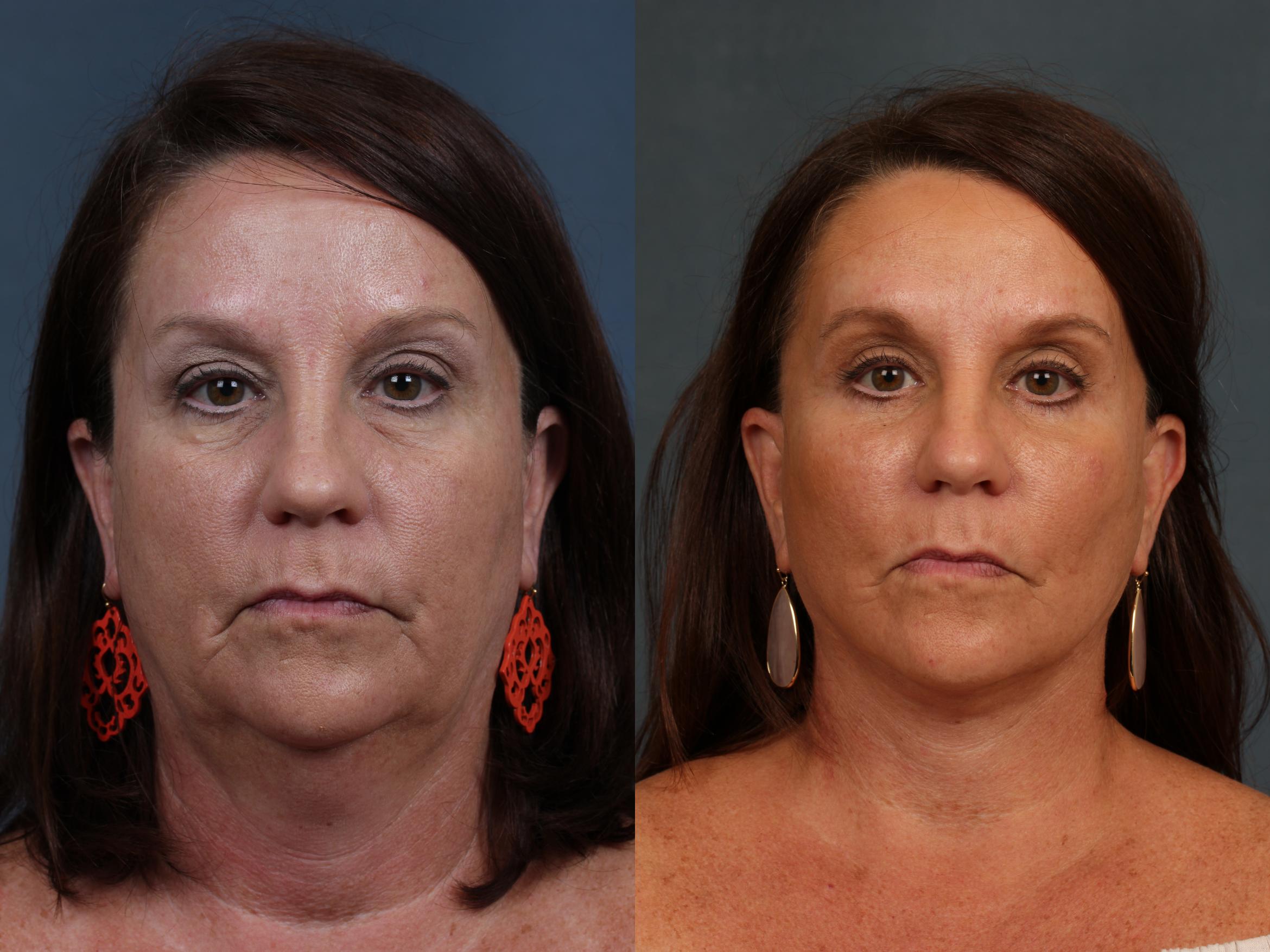 Before & After Facelift Case 496 View #1 View in Louisville, KY