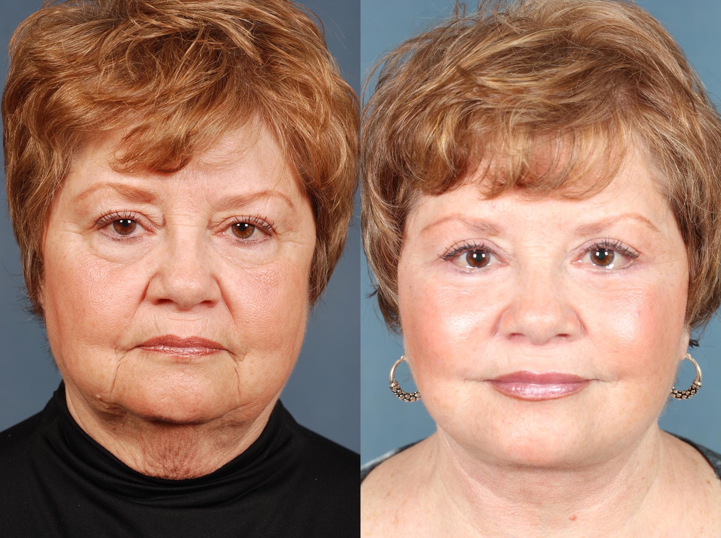 Before & After Facelift Case 502 View #1 View in Louisville & Lexington, KY