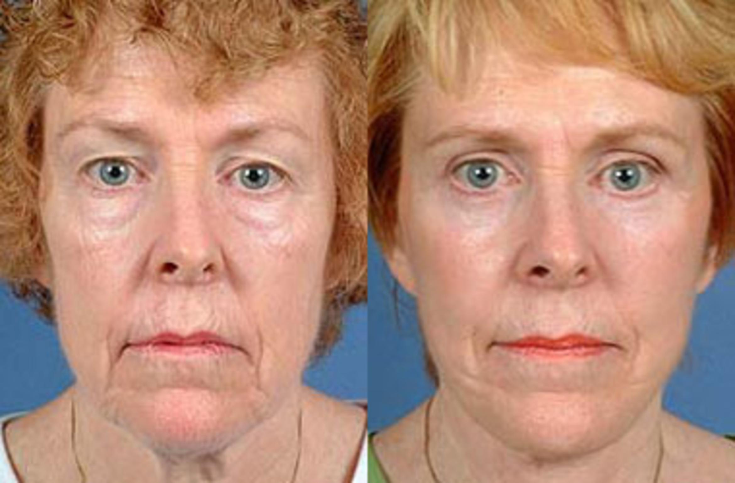 Before & After Facelift Case 69 View #1 View in Louisville & Lexington, KY