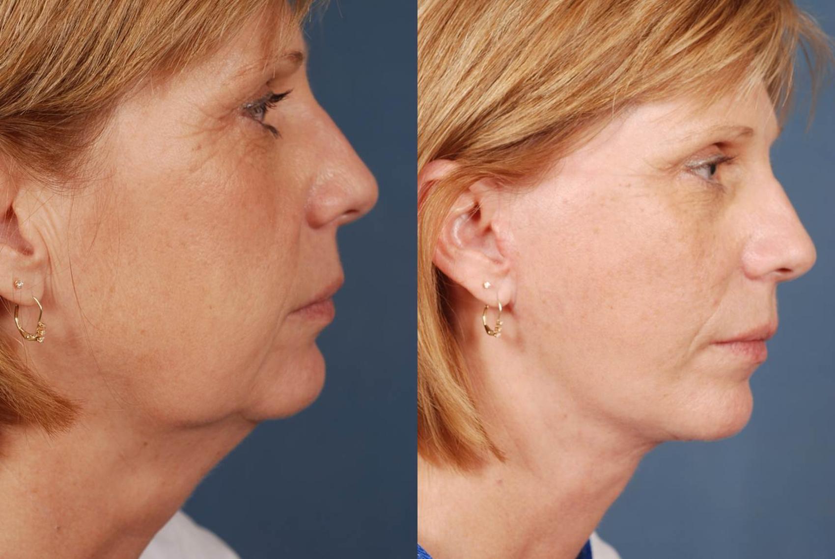 Before & After Facelift Case 237 View #3 View in Louisville, KY