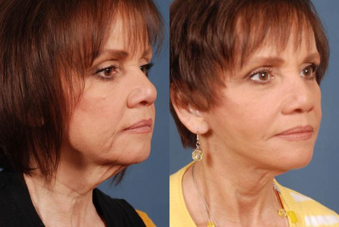 Before & After Facelift Case 238 View #2 View in Louisville & Lexington, KY