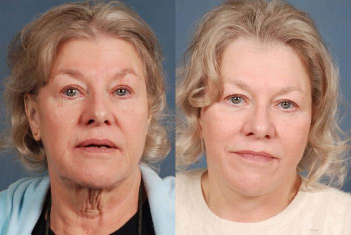 Before & After Facelift Case 239 View #1 View in Louisville & Lexington, KY