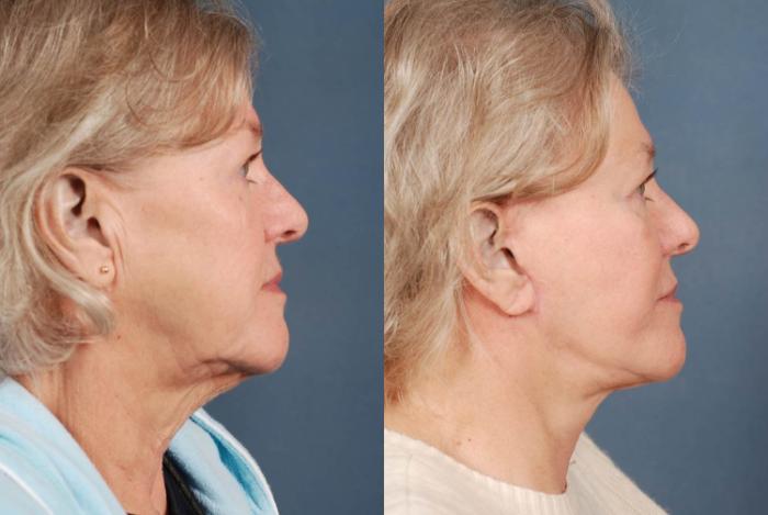 Before & After Facelift Case 239 View #3 View in Louisville & Lexington, KY