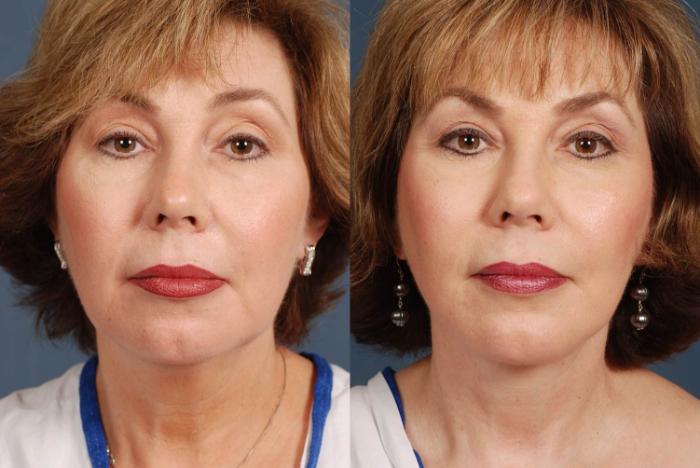 Before & After Facelift Case 240 View #1 View in Louisville & Lexington, KY
