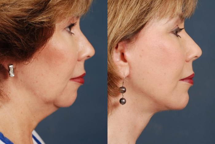 Before & After Facelift Case 240 View #3 View in Louisville & Lexington, KY