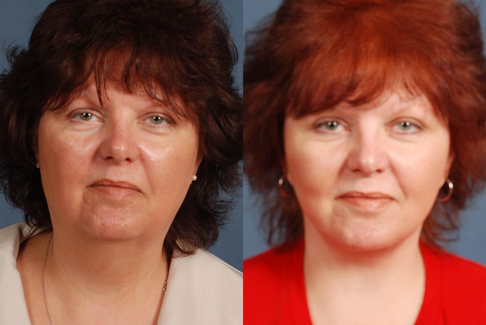 Facelift Case 241 Before & After View #1 | Louisville, KY | CaloSpa® Rejuvenation Center