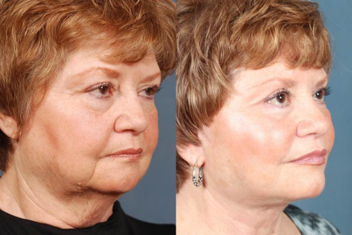 Before & After Facelift Case 242 View #2 View in Louisville & Lexington, KY