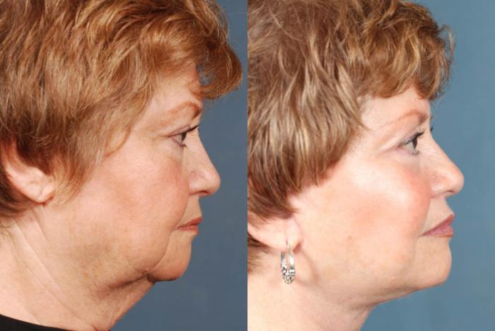 Before & After Facelift Case 242 View #3 View in Louisville & Lexington, KY