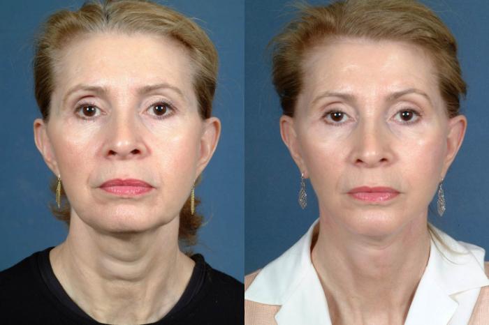 Before & After Facelift Case 243 View #1 View in Louisville & Lexington, KY