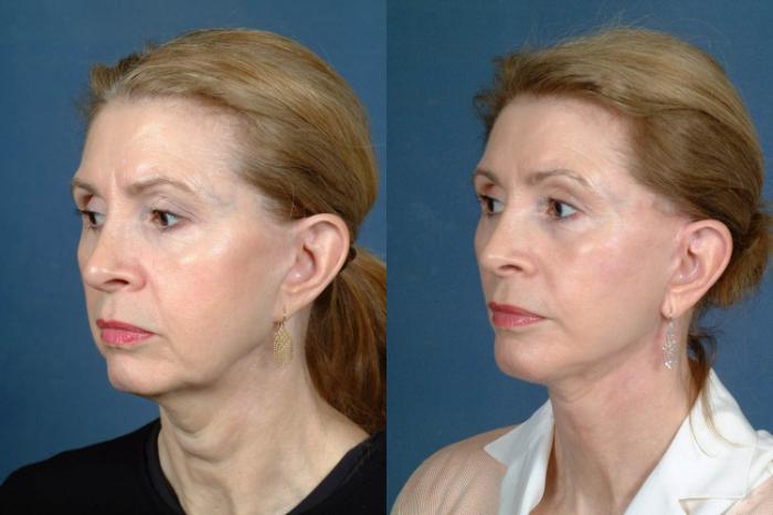 Before & After Facelift Case 243 View #2 View in Louisville & Lexington, KY