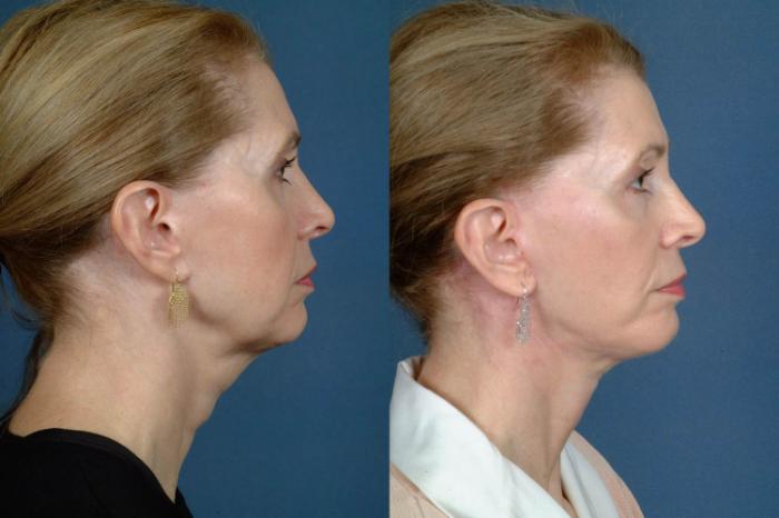 Before & After Facelift Case 243 View #3 View in Louisville & Lexington, KY