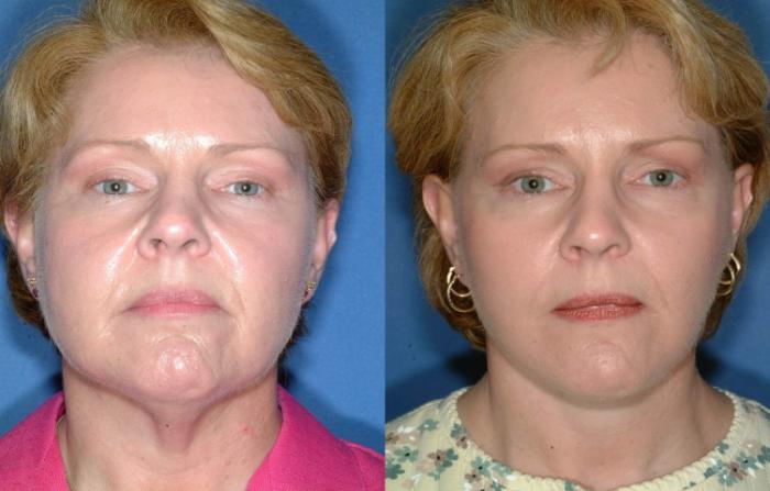 Facelift Case 244 Before & After View #1 | Louisville, KY | CaloSpa® Rejuvenation Center