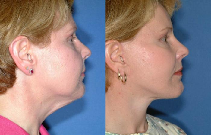 Before & After Facelift Case 244 View #3 View in Louisville & Lexington, KY