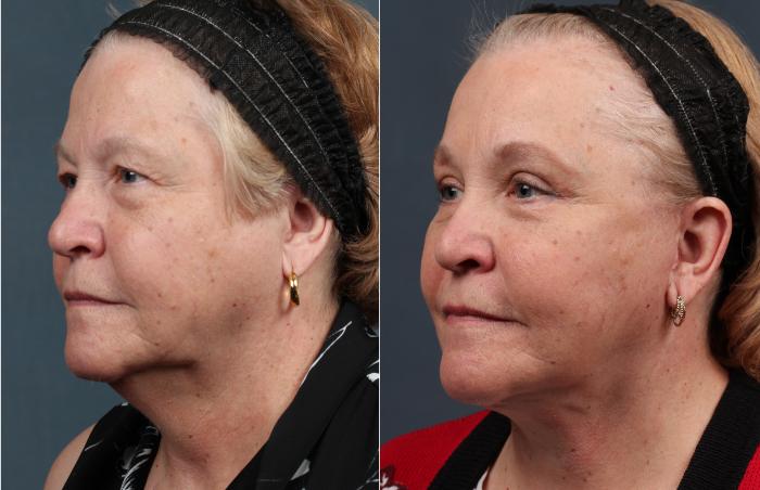Before & After Facelift Case 282 View #1 View in Louisville & Lexington, KY