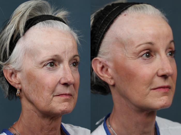 Before & After Facelift Case 491 View #2 View in Louisville & Lexington, KY