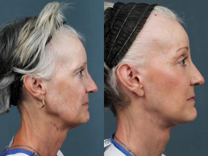 Facelift Case 491 Before & After View #3 | Louisville, KY | CaloSpa® Rejuvenation Center