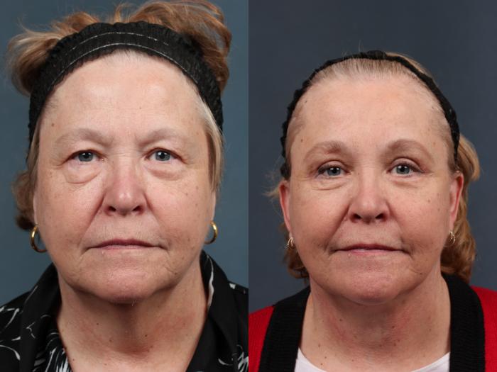 Facelift Case 492 Before & After View #1 | Louisville, KY | CaloSpa® Rejuvenation Center