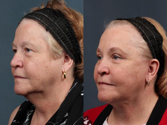 Facelift Case 492 Before & After View #2 | Louisville, KY | CaloSpa® Rejuvenation Center