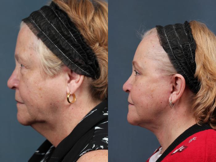 Facelift Case 492 Before & After View #3 | Louisville, KY | CaloSpa® Rejuvenation Center