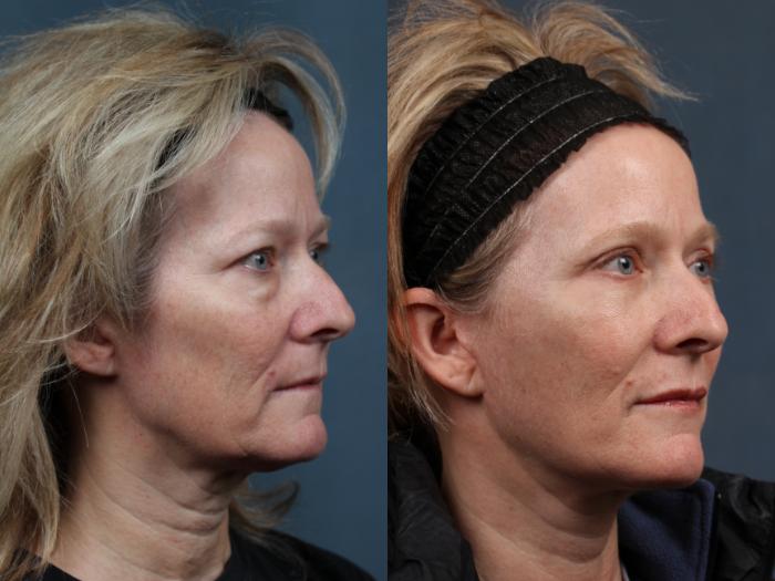 Facelift Case 495 Before & After View #2 | Louisville, KY | CaloSpa® Rejuvenation Center