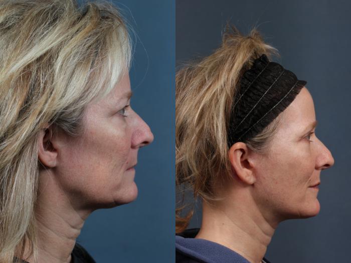 Facelift Case 495 Before & After View #3 | Louisville, KY | CaloSpa® Rejuvenation Center