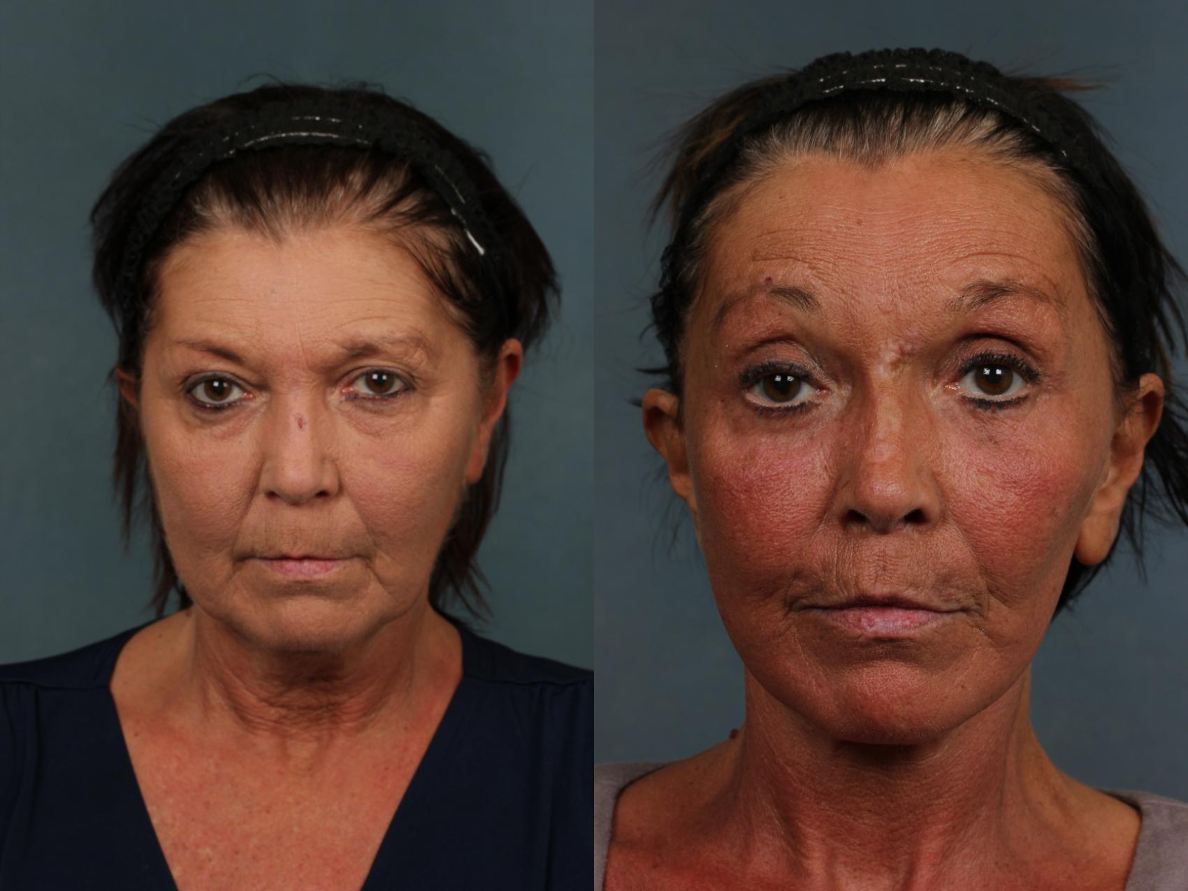 Before & After Facelift Case 497 View #1 View in Louisville & Lexington, KY