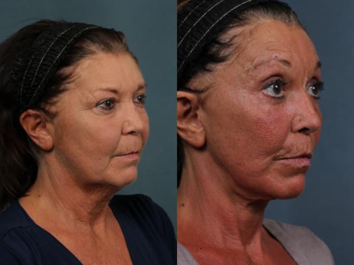 Facelift Case 497 Before & After View #3 | Louisville, KY | CaloSpa® Rejuvenation Center