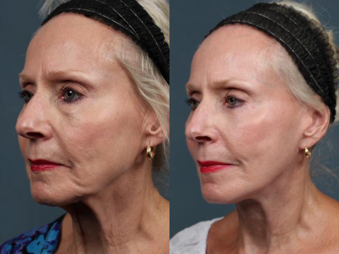 Before & After Facelift Case 498 View #2 View in Louisville & Lexington, KY