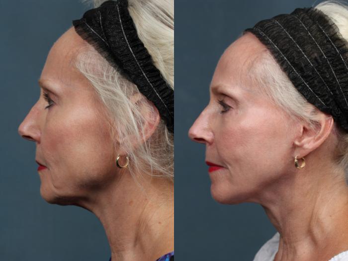 Before & After Facelift Case 498 View #3 View in Louisville & Lexington, KY