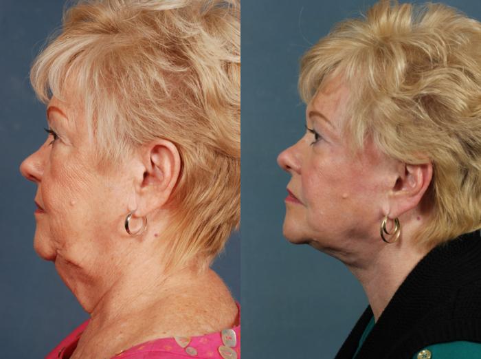 Before & After Facelift Case 500 View #2 View in Louisville & Lexington, KY