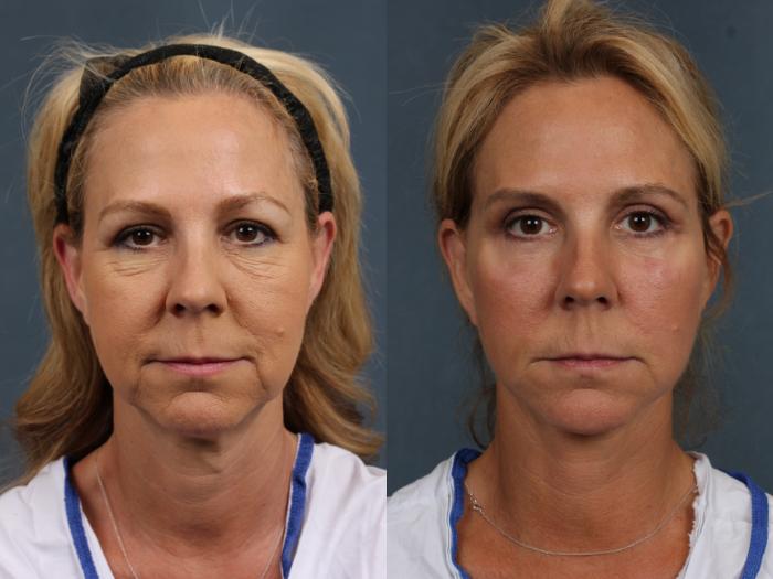Before & After Facelift Case 501 View #1 View in Louisville, KY