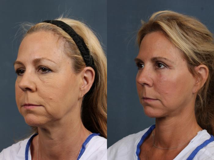 Facelift Case 501 Before & After View #2 | Louisville, KY | CaloSpa® Rejuvenation Center