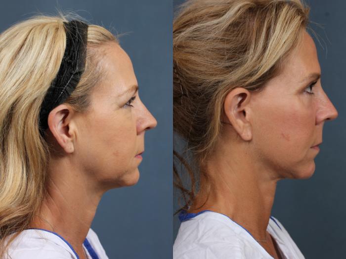 Before & After Facelift Case 501 View #3 View in Louisville & Lexington, KY