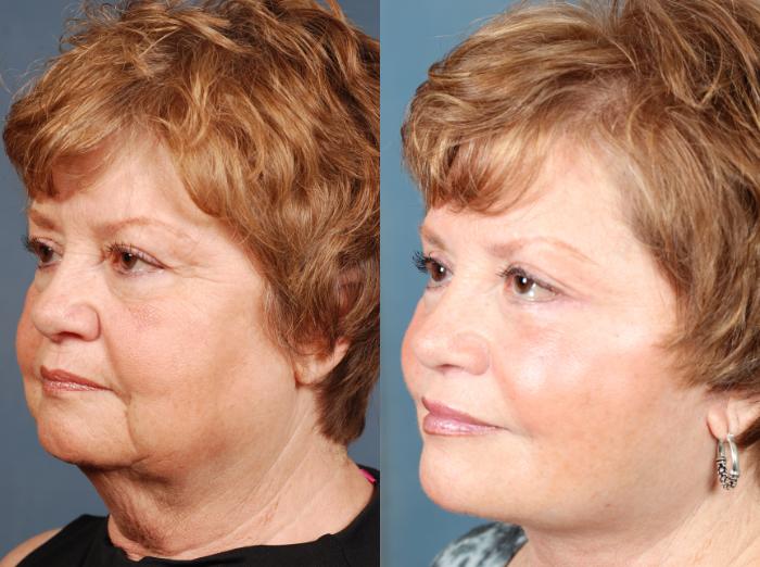 Before & After Facelift Case 502 View #2 View in Louisville & Lexington, KY