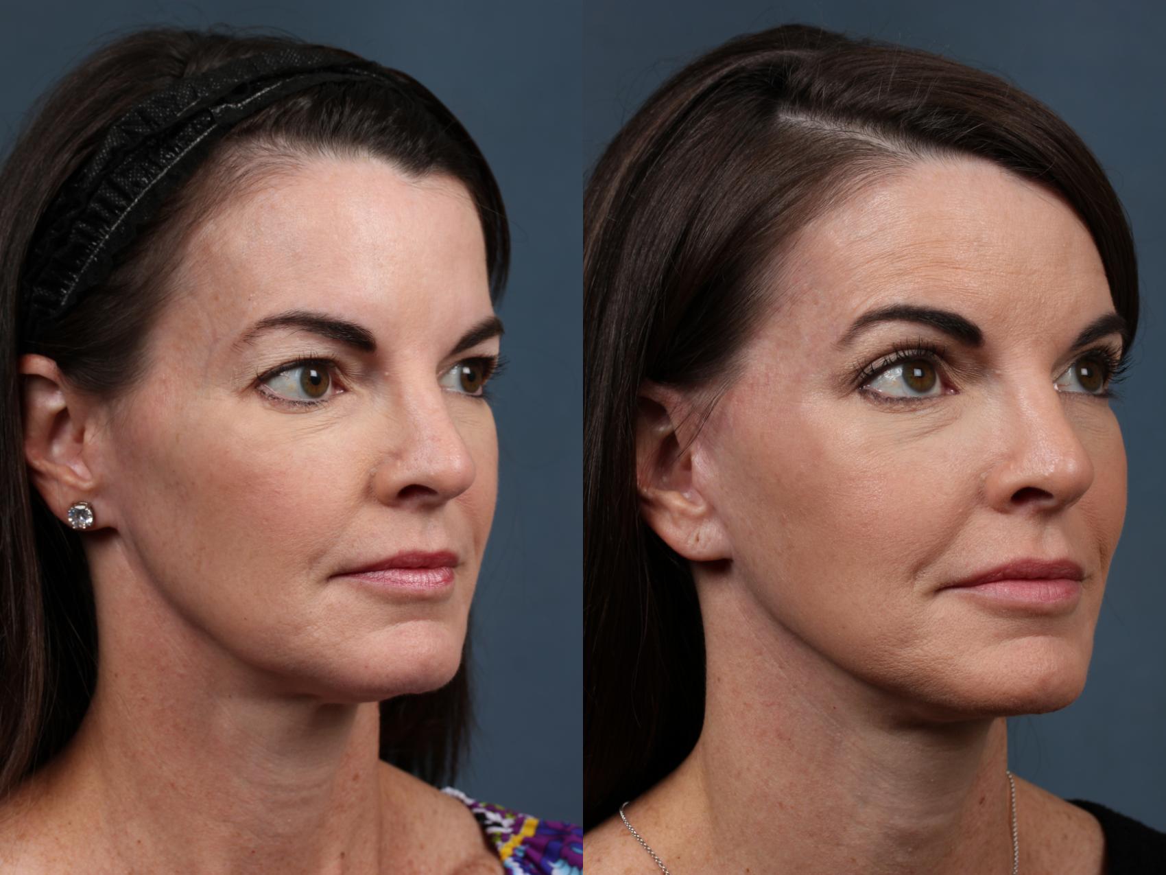 Before & After Facelift Case 503 View #2 View in Louisville & Lexington, KY