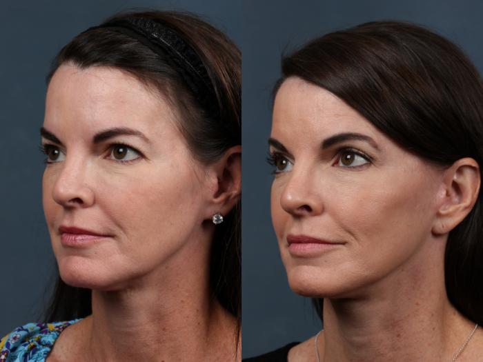 Facelift Case 503 Before & After View #3 | Louisville, KY | CaloSpa® Rejuvenation Center