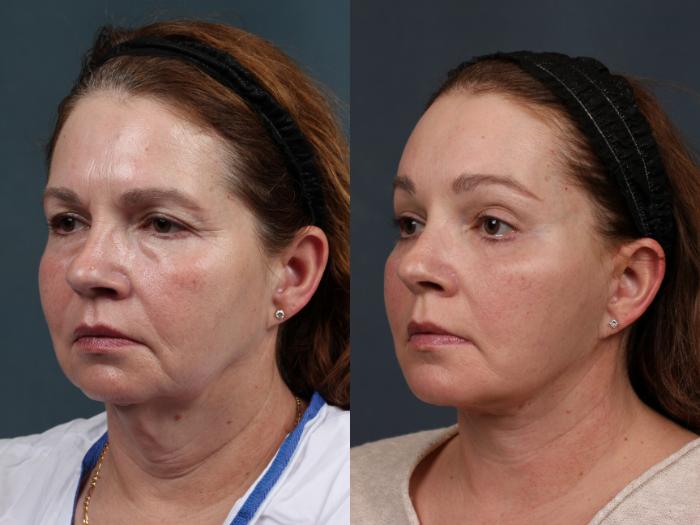 Facelift Case 504 Before & After View #2 | Louisville, KY | CaloSpa® Rejuvenation Center