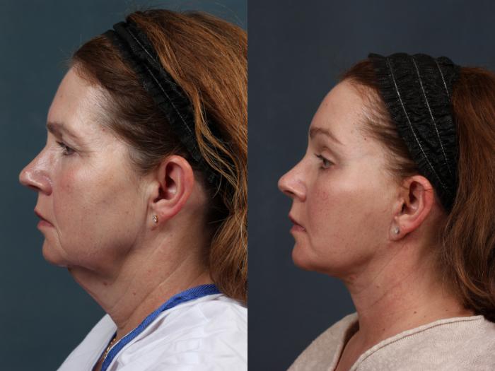 Facelift Case 504 Before & After View #3 | Louisville, KY | CaloSpa® Rejuvenation Center