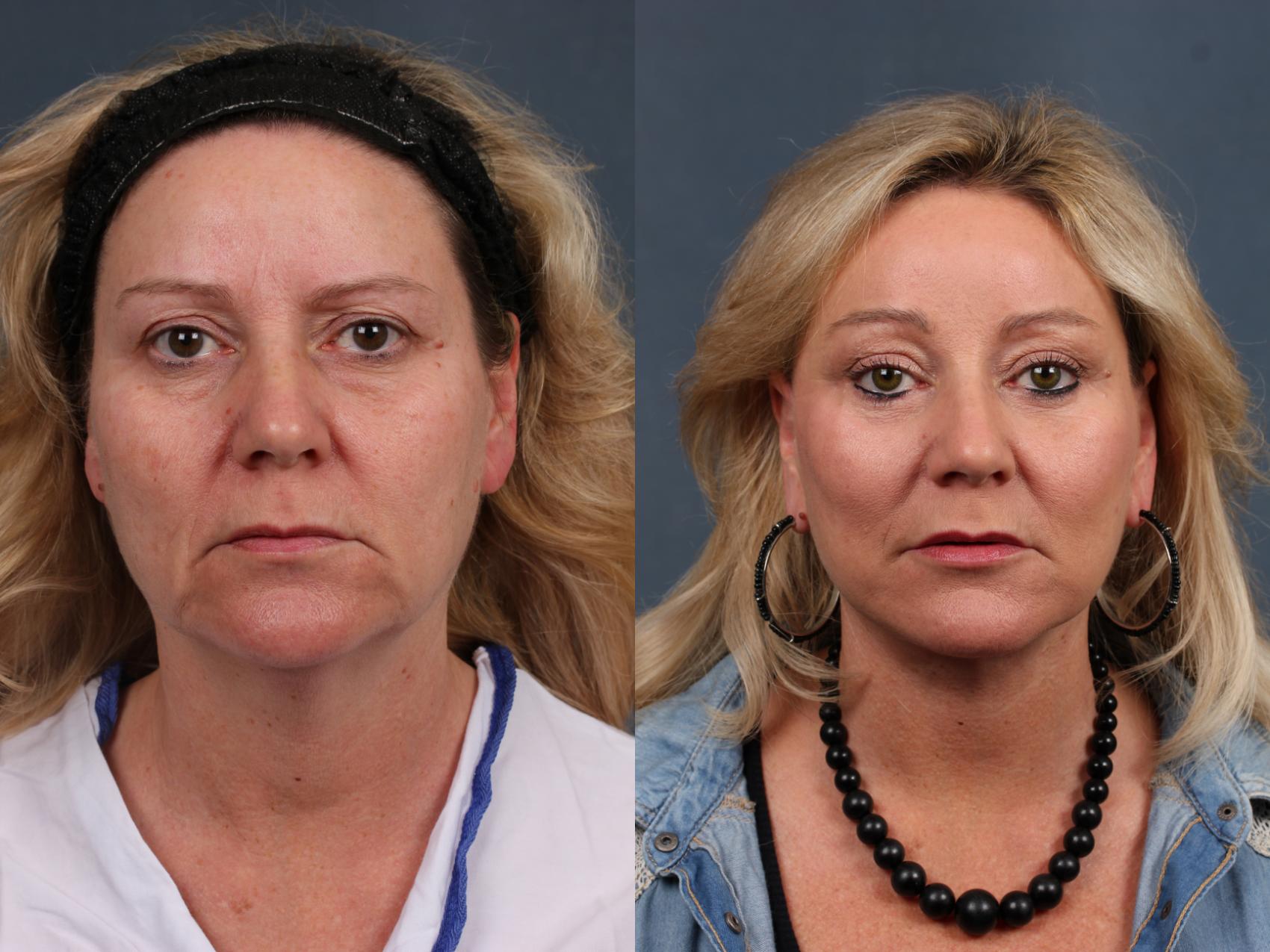 Before & After Facelift Case 506 View #1 View in Louisville & Lexington, KY