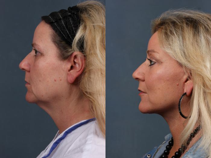 Facelift Case 506 Before & After View #2 | Louisville, KY | CaloSpa® Rejuvenation Center