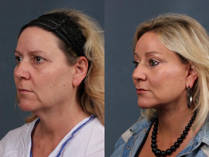 Facelift Case 506 Before & After View #3 | Louisville, KY | CaloSpa® Rejuvenation Center