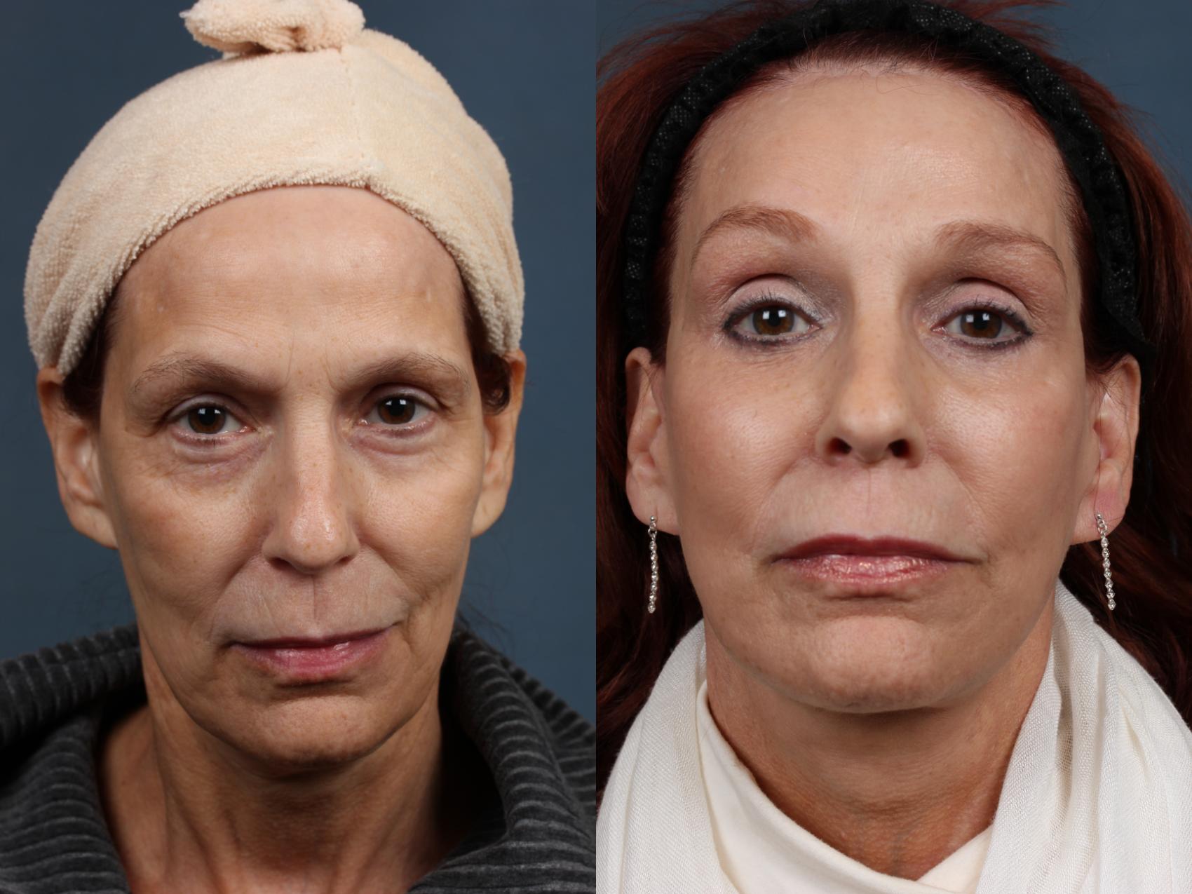 Facelift Case 509 Before & After View #1 | Louisville, KY | CaloSpa® Rejuvenation Center