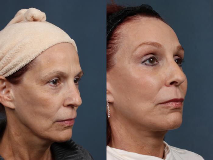 Before & After Facelift Case 509 View #2 View in Louisville & Lexington, KY