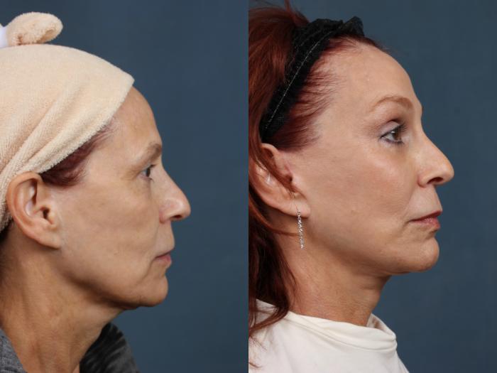 Facelift Case 509 Before & After View #3 | Louisville, KY | CaloSpa® Rejuvenation Center